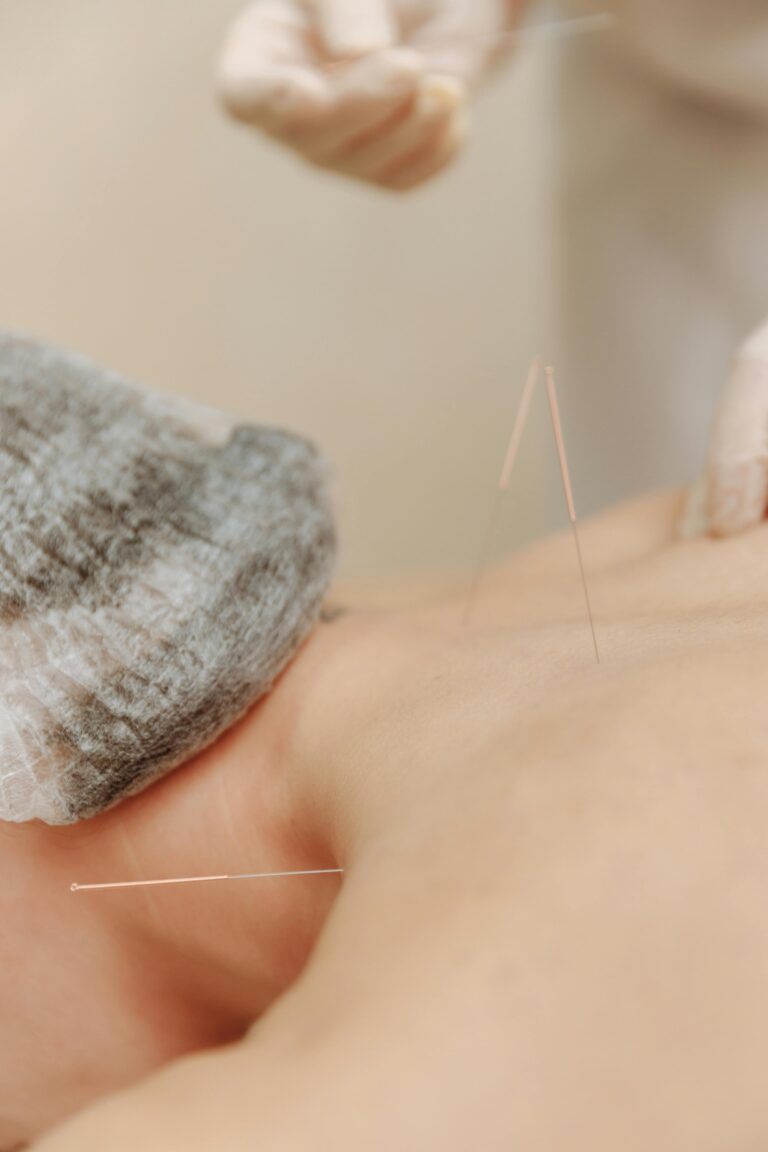 Natruopathic doctor doing acupuncture